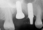 Figure 5 Periapical radiograph of new implant
in first molar site.