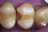 Fig 14. Porcelain-layered zirconia framework (CL-IIIb) with layered pink porcelain for the gingiva (Fig 13); final image in the mouth of the porcelain-layered zirconia framework (Fig 14) (images courtesy of Aram Torosian, MDC).