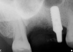 Figure 4 Periapical radiograph of grafted socket following implant removal.