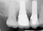 Figure 3 Periapical radiograph following restoration with cemented crown using a stock abutment. Radiopacity of cement was not highly
visible possibly due to a change in beam
angulation.