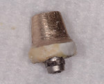 Figure 9 Custom abutment with adherent, hard, yellowish and whitish material consistent with REC.