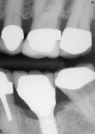 Figure 13 Radiograph taken 1 year following implant placement showing good bone levels with a slight open margin on the distal between the crown and custom abutment.