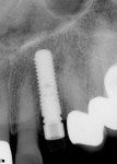 Figure 17 Periapical radiograph taken immediately after placement showing implant 2-mm subcrestal with an immediate provisional.