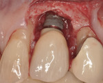 Figure 23 Clinical view following cement removal showing extensive circumferential bone loss despite meticulous abutment and restoration design.