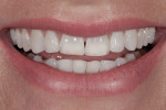 Figure 6 The patient’s irregular anterior incisal plane was more evident in a full, uninhibited smile.