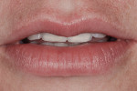 Figure 5 The patient had a “0” position of canine, with the cusp tip of canine level with the lip in the repose position.