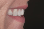 Figure 7 The lateral view revealed the retrusive nature of the incisor teeth.