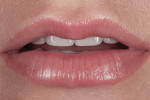 Figure 11 The patient now had a more even, symmetrical display of incisors in repose.