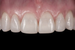 Figure 13 Close-up view of composite added to teeth Nos. 6 through 11.