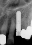 Figure 18 Periapical radiograph of healed implant 3 months after placement with crestal bone level with the head of the implant.