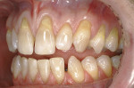 Figure 1b  Preoperative presentation of a patient exhibiting multiple adjacent gingivalrecession defects ranging from teeth Nos. 8 through 14. Notice that with a diastema present, elevatingthe midline papilla would have created additional risk of fur