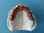 The overdenture bar with soft tissue and the internal framework processed in acrylic