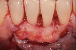 Figure 5. Treatment of the recessions in the
mandibular anterior segment: coronal advancement flap…