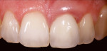 Figure 8. Tooth No. 21 cannot be preserved. The challenge here is the mesially eccentric gingival line of tooth No. 11.