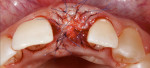 Figure 9. After careful extraction of tooth No. 21, soft tissue from the tuberosity area was grafted.