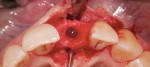 Figure 10. Eight weeks after extraction, the apical region was augmented and an implant inserted.