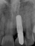 Figure 18. Final radiograph of the prototype restoration.