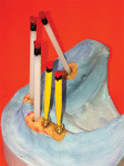 Figure 1. Along with the divergence of about 25 degrees on the lower-right posterior implant, the proximity to the retromolar pad made using a stock abutment impossible.