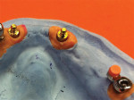 Figures 6 and 7. All abutments placed on model and Rhein83 soft retention caps placed on the custom abutment balls framework using acrylic.
