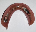 Figure 11. The case was returned to the laboratory after 4 years to have the Rhein83 inserts changed. The prosthesis shows little wear and continues to work well for this patient.
