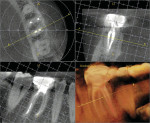 Figure 3  An endodontically treated tooth imaged using the Kodak 9000 3D with images demonstrating the InVivoDental software.