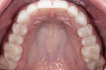 Figure 2 Note the upper arch with minimal pit/
fissure restorations in the premolars and molars.