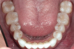 Figure 3 The lower arch also was minimally restored with only pit/fissure restorations present in premolars and molars.