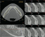 Figure 4a  Limited field of view showing high-resolution cross-sections of the teeth and adjacent periodontal structures. Images made with the Picasso Trio hybrid CBCT system.