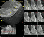 Figure 4b  Limited field of view showing high-resolution cross-sections of the teeth and adjacent periodontal structures. Images made with the 3D Accuitomo small FOV CBCT system.