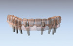 Solidex Abutments