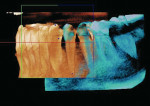 Figure 5  Examples of InVivoDental applications presently under development in which adjacent CBCTimage volumes can be stitched together to provide a larger effective FOV. Stitching of two adjacent overlapping images made with theKodak 9000 3D system