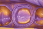 Figure 3 A high-contrast complete impression using Imprint VPS Impression Material.