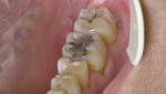 Figure 2 Quadrant III after initial periodontal therapy.