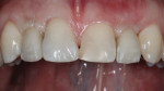 Figure 6 Implant-supported provisional restorations No. 7 and No. 10 at time of delivery 8 weeks after implant placement (early implant loading).