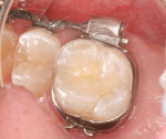 Figure 9b  Embrace WetBond sealant on maxillary first molar at 6-year recall.