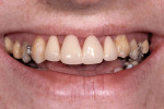 Figure 1  View of the patient's initial smile.