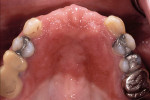 Figure 2  The patients maxillary arch. Note thewear through the existing provisionals.
