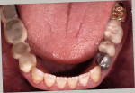 Figure 3  The patient's mandibular arch. Again,note posterior wear.