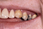 Figure 4  Note the significant over-eruption of the maxillary posterior teeth.
