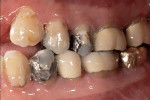 Figure 10  Lateral view after crown lengthening demonstrating exposed sound tooth structure.