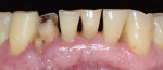 Figure 1 Initial clinical situation. Mandibular right lateral incisor was fractured.