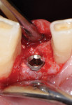 Figure 7 Implant placement; good initial stability
was achieved.