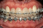 Figure 17  View following placement of brackets to aid surgeon and maxillary osteotomy. Note occlusal relationship created by the combination of the provisionals and orthognathic surgery.
