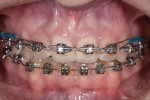Figure 1 Initial patient presentation with orthodontic brackets and wires
on both arches.