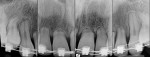 Figure 2 Preoperative periapical radiograph demonstrating advanced root resorption.