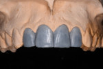 Figure 6 Diagnostic wax-up of the final restoration followed the altered soft-tissue contours.