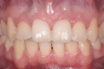 Figure 4 Preoperative view after removal of the orthodontic brackets and wires, and subsequent composite splinting. Note the harmony and continuity of form of the free gingival margin.