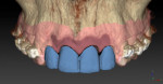 Figure 8 The diagnostic wax-up was visible as part of the initial scans of the master cast with the Procera 2G scanner. The teeth have been virtually extracted.