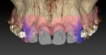 Figure 7 Initial view after SmartFusion: Volume rendering of CBCT scan and scan of cast outlining the soft tissue projected onto one image. The teeth to be extracted have been marked as such and are visualized in grey.