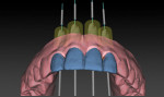 Figure 10 Virtual implant placement has been completed. Note the long axes of the implants coincide with the height of contour of the diagnostic wax-up.